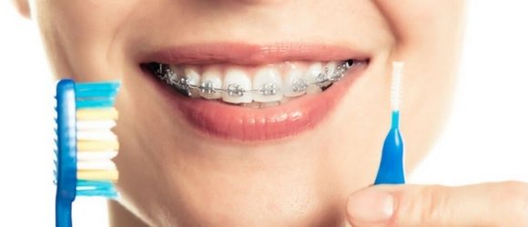 Cuidados e higiene de los dientes con brackets. Paso a paso.