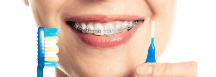 Cuidados e higiene de los dientes con brackets. Paso a paso.