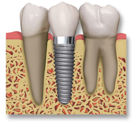 ESTUDIO DE IMPLANTES DENTALES